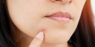 முகப்பரு iStock-1056843646_hero-1024x575-fe1e2f60